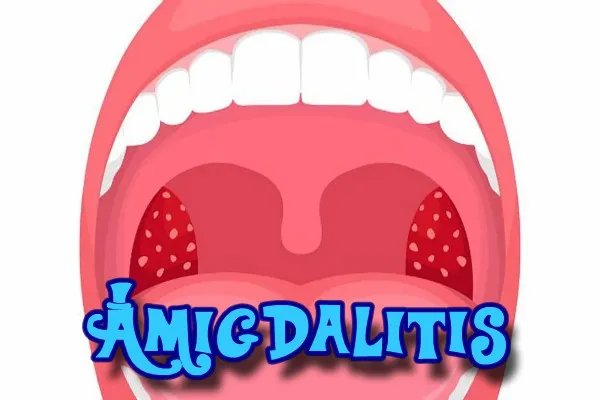 1amigdalitis.jpg?fit=600%2C400&ssl=1