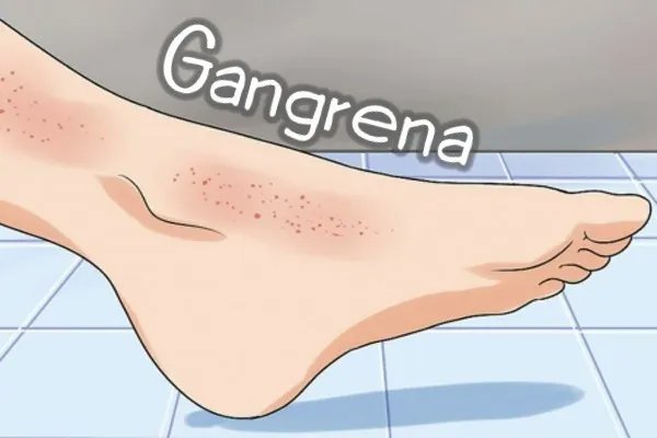 1gangrena.jpg?fit=600%2C400&ssl=1